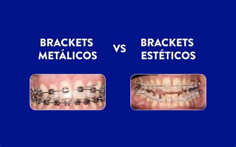 cual es mejor brackets metalicos o esteticos|bracket autoligado vs convencional.